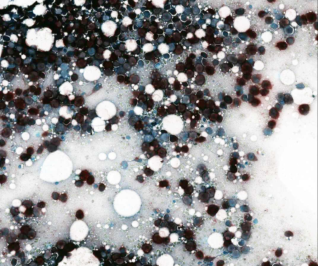 Butyrate Esterase stained touch preparation showing strong positivity in immature cells (x400)